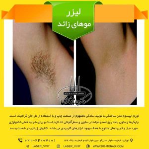 لیزر موهای زائد در تهران