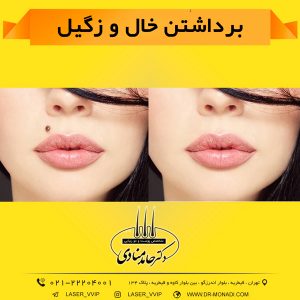 برداشتن خال و زگیل