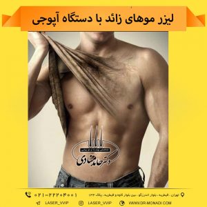 لیزر موهای زائد با دستگاه آپوجی