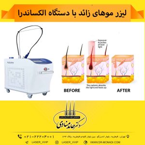 لیزر موهای زائد با دستگاه الکساندرا لیزر موهای زائد صورت و بدن سال هاست در بسیاری از مطب ها انجام می شود و هر چه زمان می گذرد، هم بر تعداد افرادی که به استفاده از لیزر برای رفع موهای زائد خود تمایل دارند