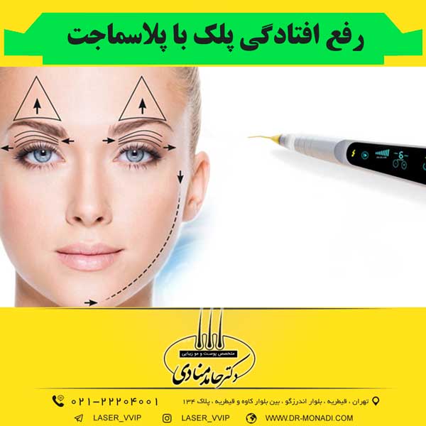 رفع افتادگی پلک با پلاسماجت