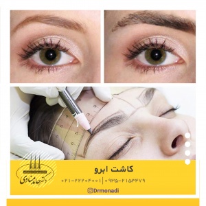 کاشت ابرو