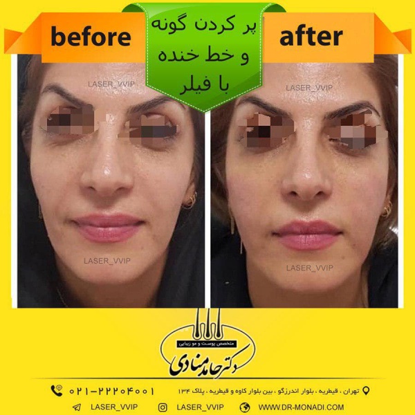 پر کردن گونه خط خنده