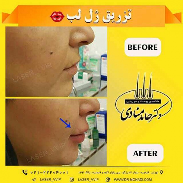 تزریق ژل لب