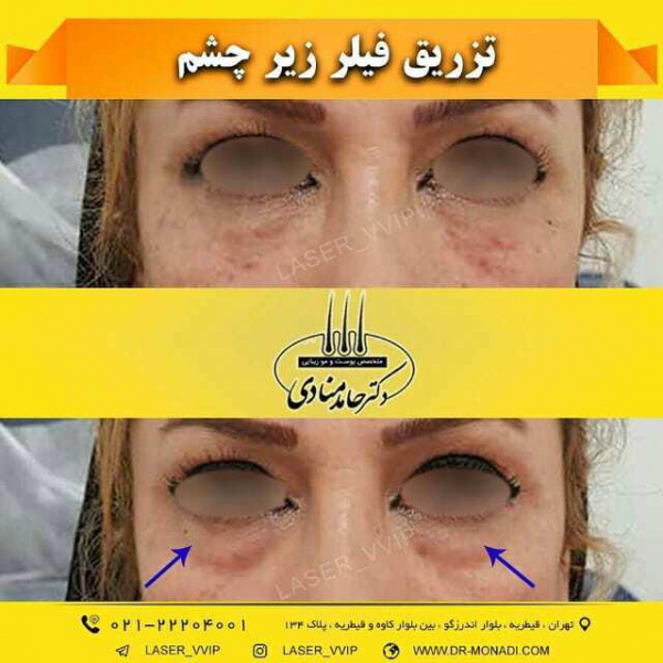 تزریق فیلر زیر چشم