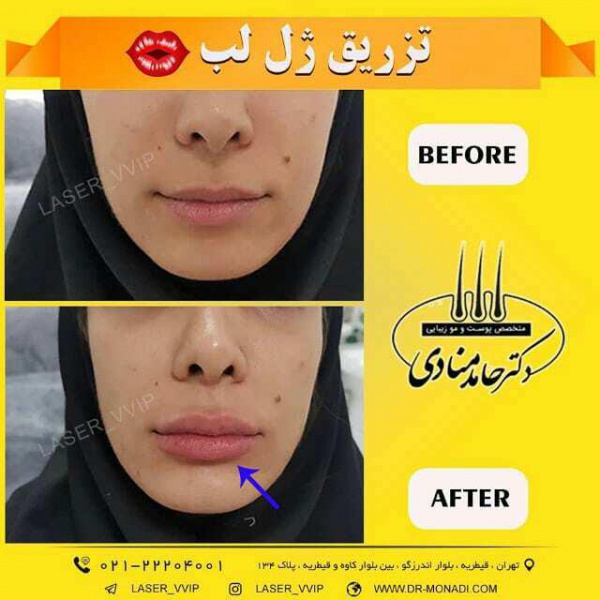 تزریق ژل لب