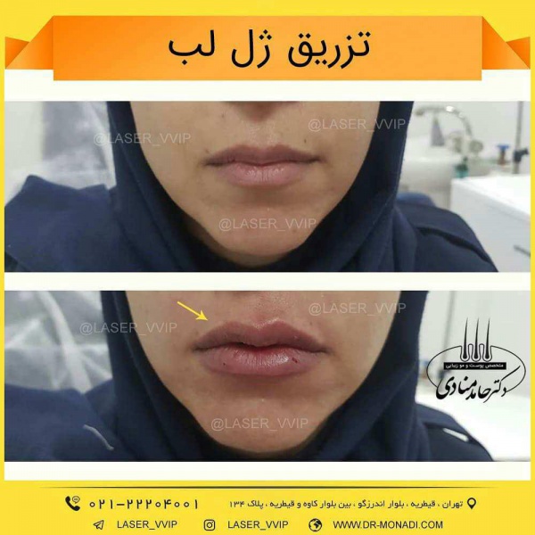 تزریق ژل لب