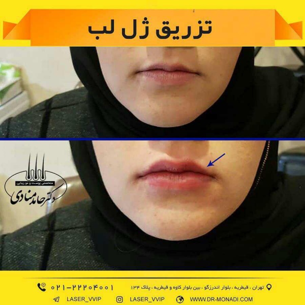 تزریق ژل لب