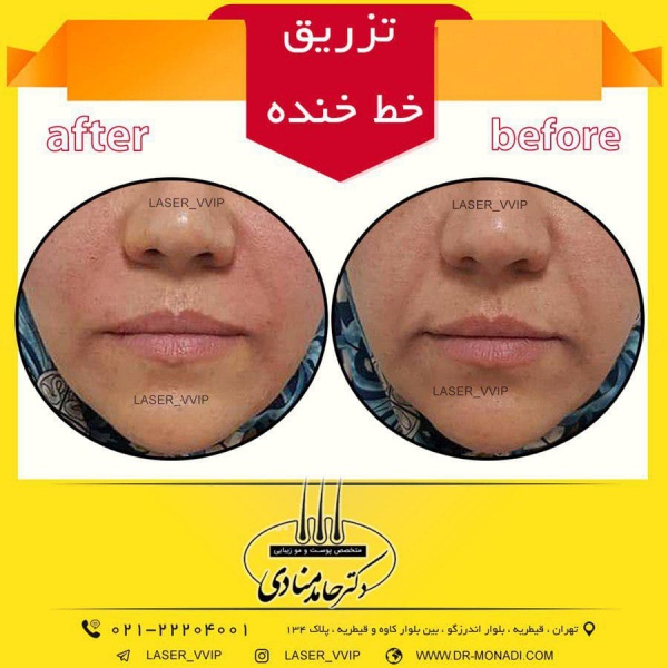 تزریق خط خنده