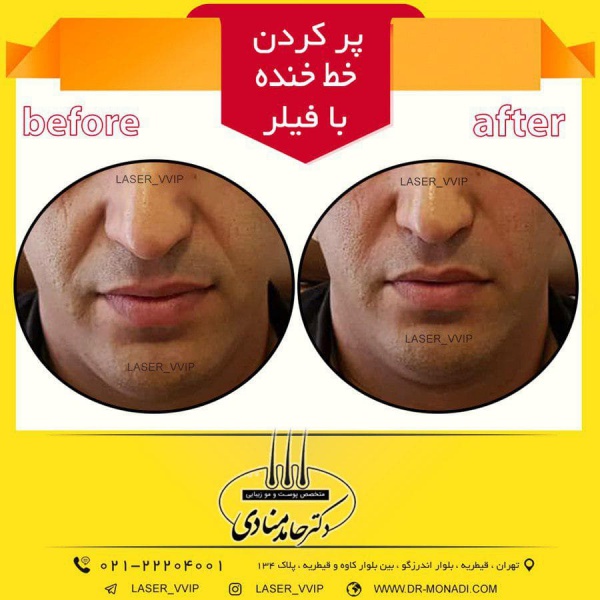 پر کردن خط خنده