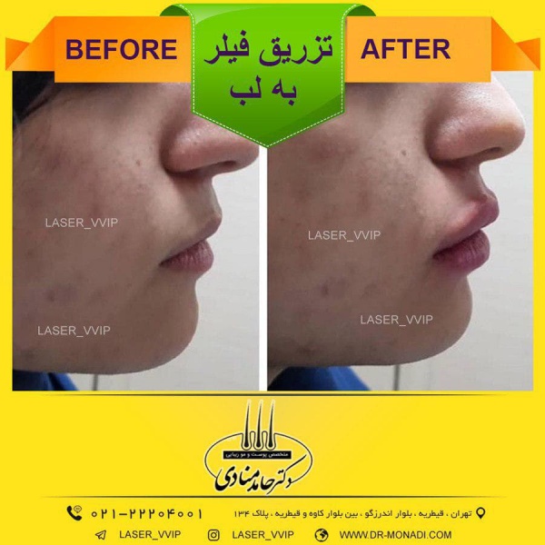 تزریق فیلر به لب