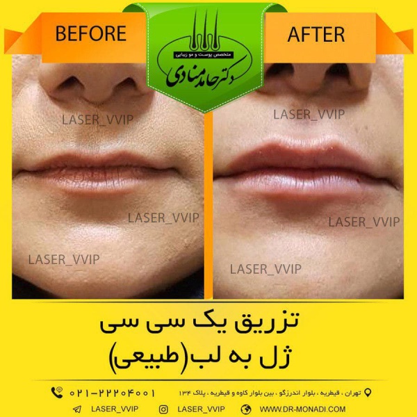 تزریق ژل لب