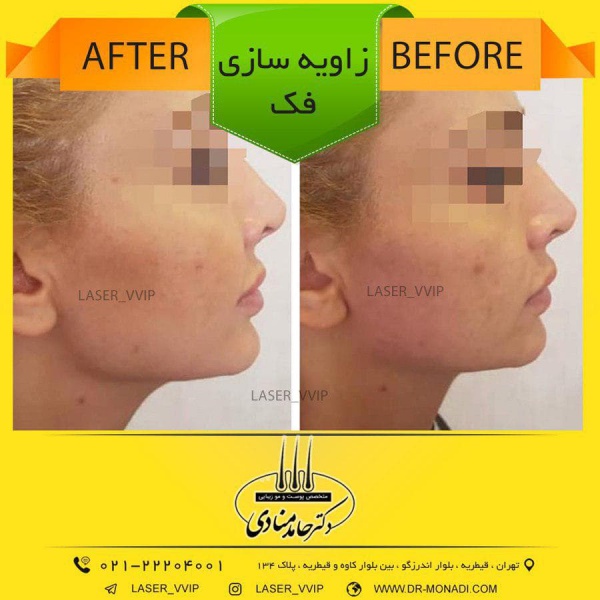 زاویه سازی فک