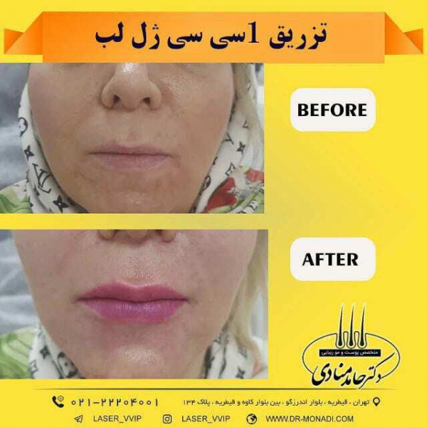 تزریق ژل لب