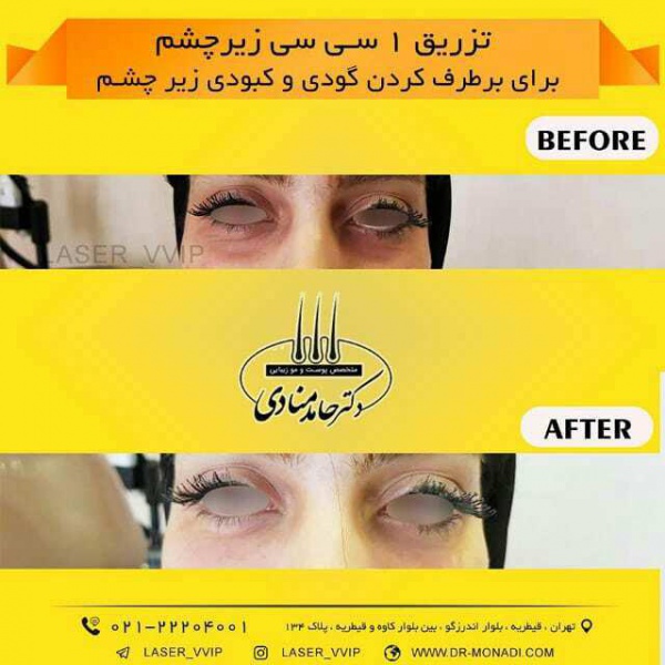 تزریق زیر چشم