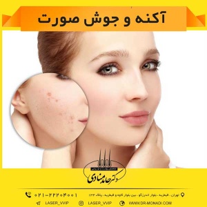 آکنه و جوش صورت