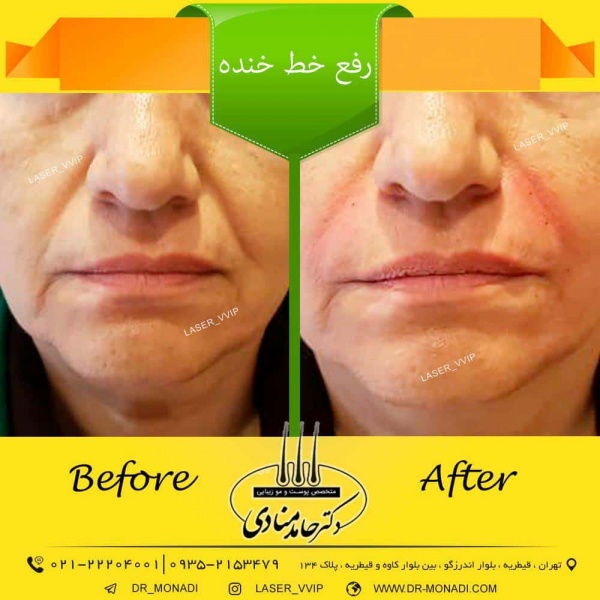 رفع خط خنده