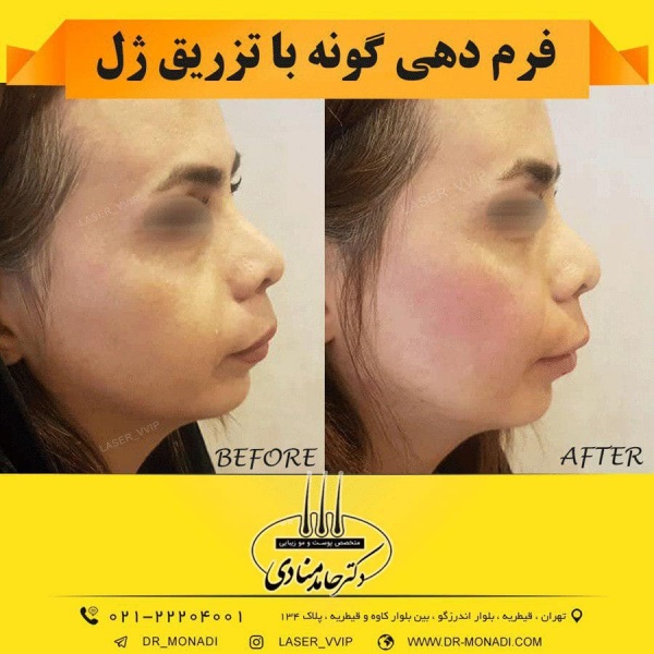 فرم دهی گونه با تزریق ژل