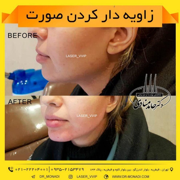 زاویه دار کردن صورت