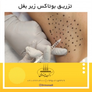 تزریق بوتاکس زیر بغل