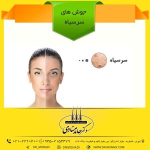 جوش های سرسیاه دکتر حامد منادی