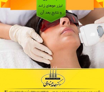 جلسه اول لیزر موهای زائد و نتایج بعد آن دکتر حامد منادی
