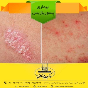 بیماری پسوریازیس دکتر حامد منادی