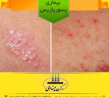 بیماری پسوریازیس دکتر حامد منادی