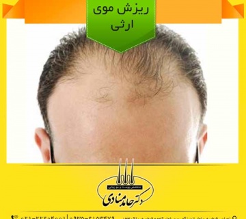 ریزش موی ارثی دکتر حامد منادی