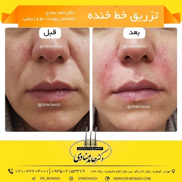 تزریق خط خنده