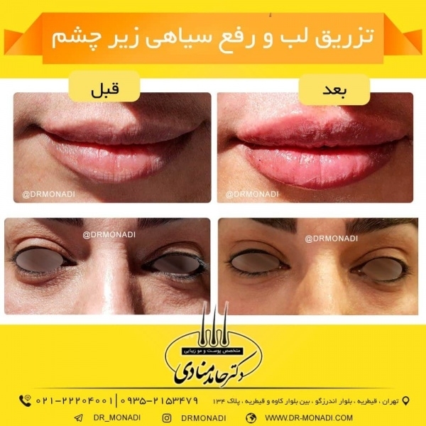 تزریق لب و رفع سیاهی چشم