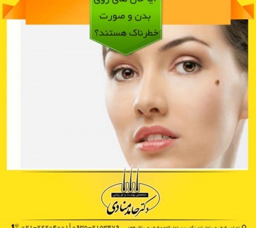 آیا خال‌ های روی بدن و صورت خطرناک هستند؟ دکتر حامد منادی