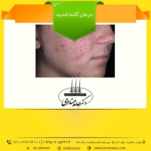 درمان آکنه شدید دکتر حامد منادی