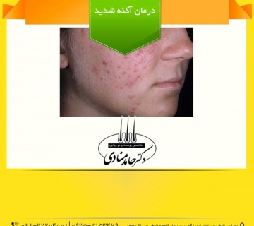 درمان آکنه شدید دکتر حامد منادی
