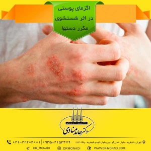 اگزمای پوستی در اثر شستشوی مکرر دستها دکتر حامد منادی