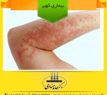 بیماری کهیر دکتر حامد منادی