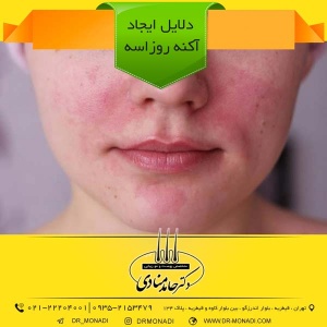 دلایل ایجاد آکنه روزاسه دکتر حامد منادی