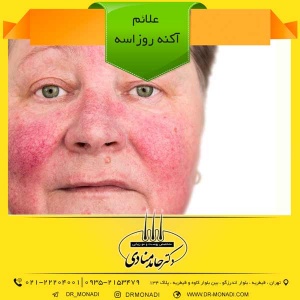 علائم آکنه روزاسه دکتر حامد منادی