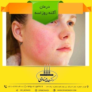 درمان آکنه روزاسه دکتر حامد منادی