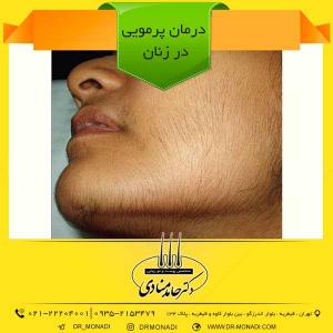 درمان پرمویی در زنان دکتر حامد منادی