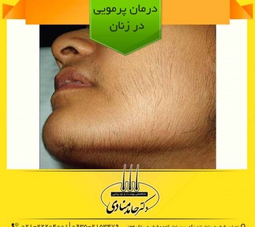 درمان پرمویی در زنان دکتر حامد منادی