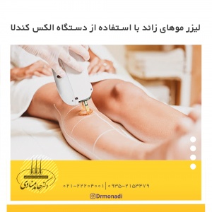 لیزر موهای زائد با استفاده از دستگاه الکس کندلا